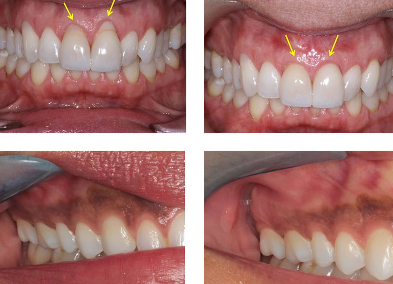 Laser Gum Treatment & Lemke Periodontics & Dental Implants
